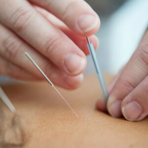Physician using acupuncture needles on a patient's back